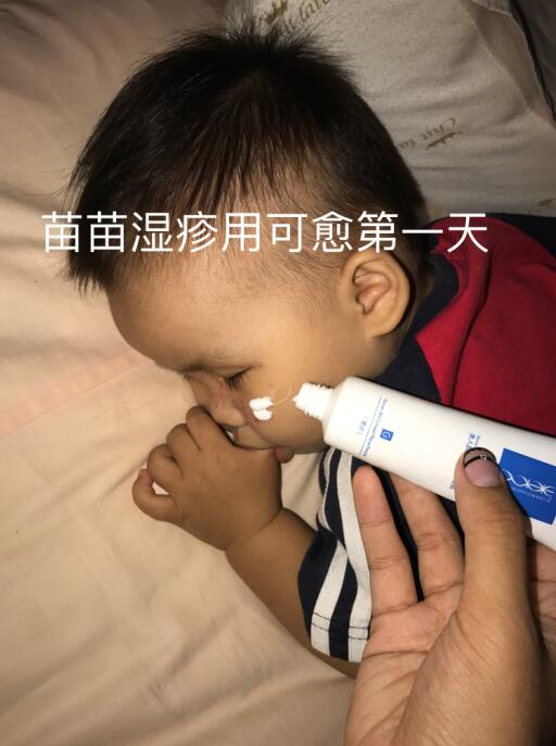 好心情好反馈 黄玉家的苗苗宝宝脸上起了湿疹，机智的妈妈赶快给苗苗涂了可愈，坚持使用四天后基本全愈，忍不住要给她点36个赞