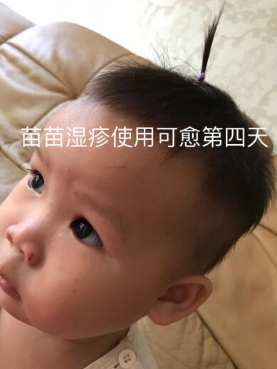 好心情好反馈 黄玉家的苗苗宝宝脸上起了湿疹，机智的妈妈赶快给苗苗涂了可愈，坚持使用四天后基本全愈，忍不住要给她点36个赞