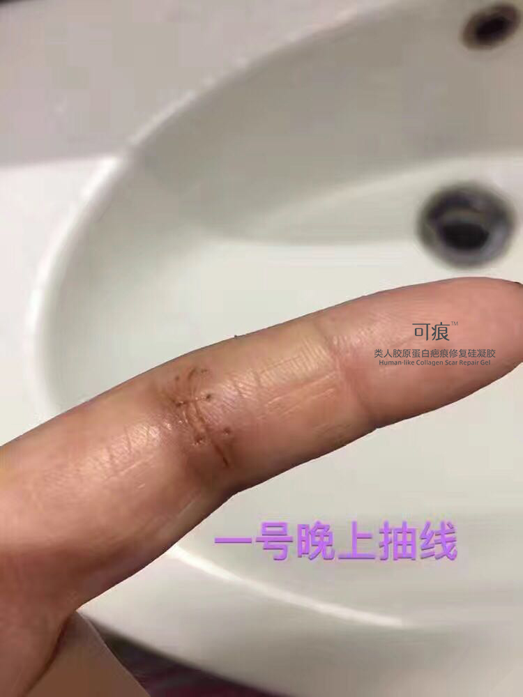 感谢欢欢的反馈图图中手指被割伤缝了几针，抽线后开始使用可痕（建议大家伤口愈合掉痂以后再使用）坚持使用了二十几天，去疤效果很明显