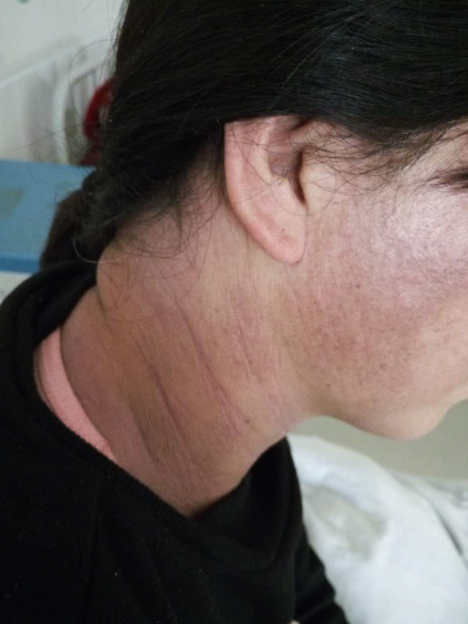 照片里的可怜人，由于头发焗油而导致全身过敏性皮炎，在诊所看了一个月没有好转，用可丽金健肤喷雾+可愈16天后的效果，可见类人胶原蛋白对肌肤修复的功效有多强大