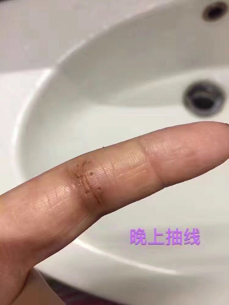 好心情好反馈 感谢欢欢的反馈图，她手指被割伤缝了几针，抽线后开始使用可痕（建议大家伤口愈合掉痂以后再使用），她坚持使用了20天，去疤效果非常明显