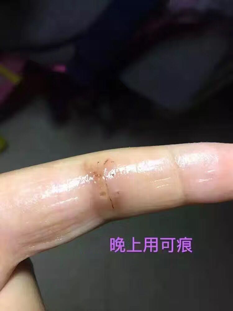 好心情好反馈 感谢欢欢的反馈图，她手指被割伤缝了几针，抽线后开始使用可痕（建议大家伤口愈合掉痂以后再使用），她坚持使用了20天，去疤效果非常明显