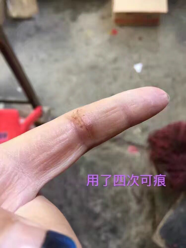 好心情好反馈 感谢欢欢的反馈图，她手指被割伤缝了几针，抽线后开始使用可痕（建议大家伤口愈合掉痂以后再使用），她坚持使用了20天，去疤效果非常明显