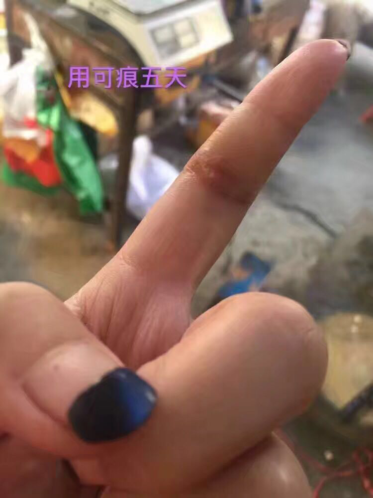 好心情好反馈 感谢欢欢的反馈图，她手指被割伤缝了几针，抽线后开始使用可痕（建议大家伤口愈合掉痂以后再使用），她坚持使用了20天，去疤效果非常明显