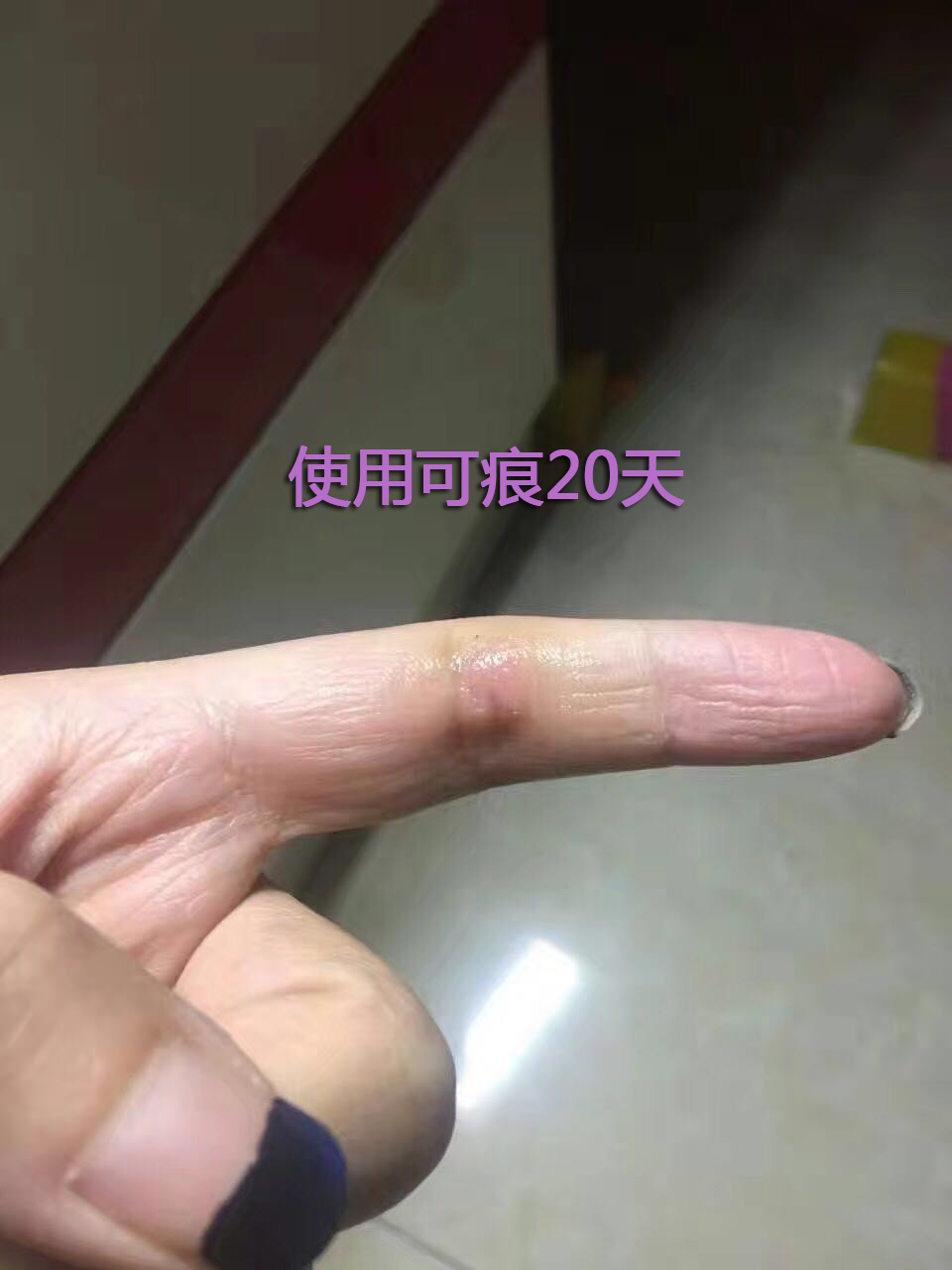 好心情好反馈 感谢欢欢的反馈图，她手指被割伤缝了几针，抽线后开始使用可痕（建议大家伤口愈合掉痂以后再使用），她坚持使用了20天，去疤效果非常明显