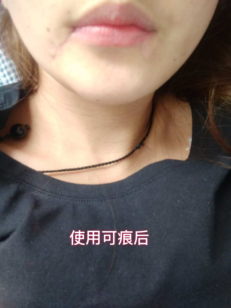 好心情好反馈 很开心可痕能帮到这位美女，车祸后她面临的不仅是面部修复，还有心理重建，很幸运，可痕不仅修复了疤痕，还帮她找回了自信，看到最后一张照片，你就明白可痕存在的意义了。而她也同意我们能把她的经历分享给大家，希望能帮助更多的人！