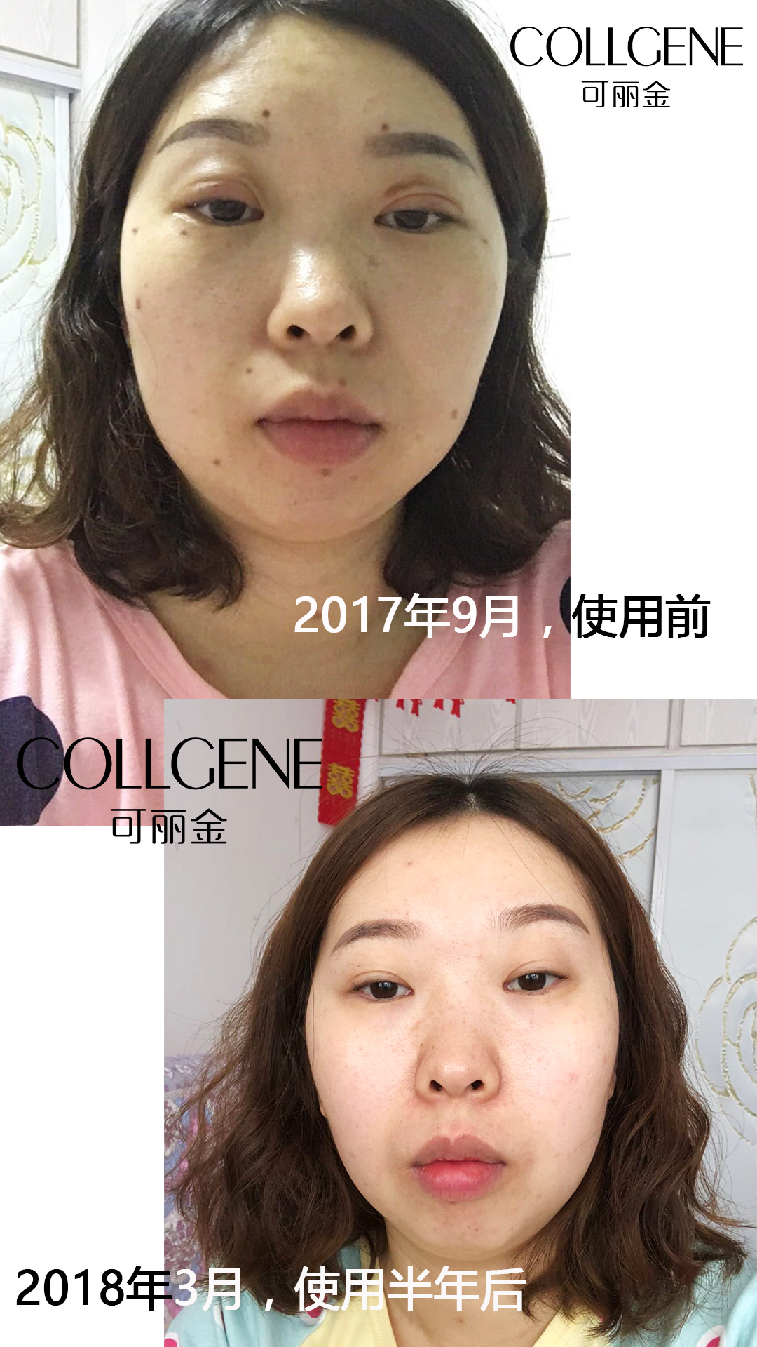 反馈来啦 17年9月，我做完点痣和割双眼皮之后留下很多疤点，机缘巧合下开始使用可丽金产品，一段时间后就发现皮肤改善非常明显，脸上的印记、斑点都慢慢地淡化了 ，使用半年多，双眼皮也恢复的非常自然，非常感谢可丽金~ 日常护肤产品搭配：健肤（喷雾+精华喷雾+隔离霜）+赋能（精华露+ 赋能明眸霜+ 多效修复霜+深化面膜）